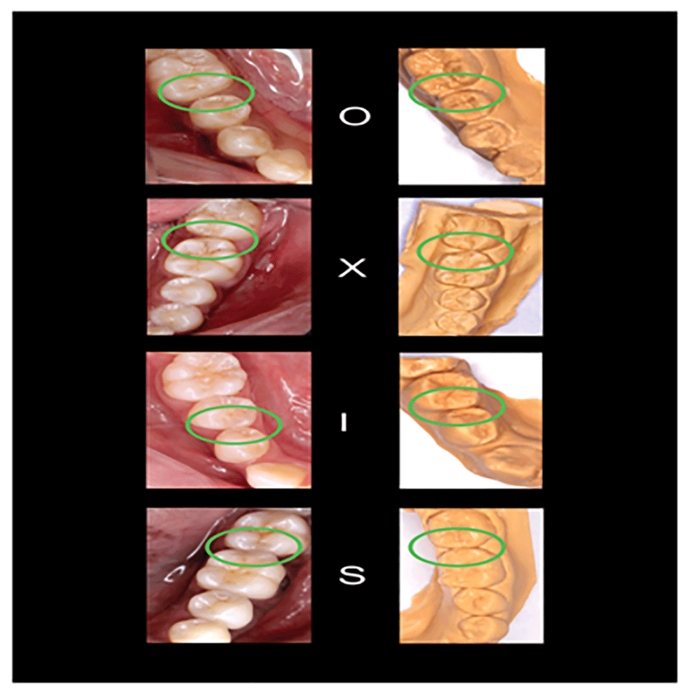 Tooth Contact Exceptions Interproximal Contacts Teeth